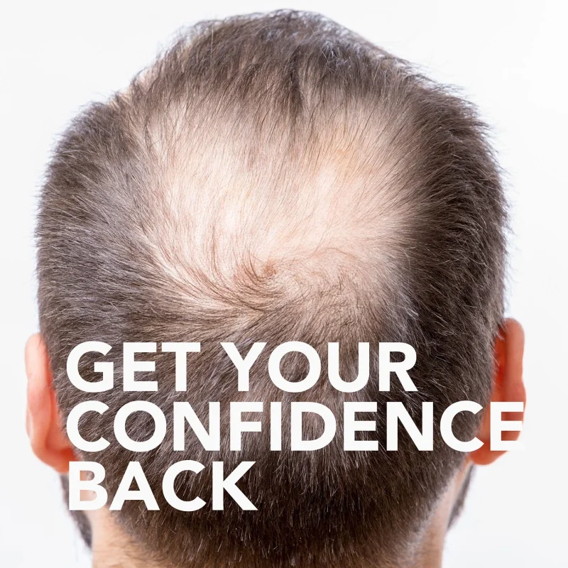 Member’s Mark Minoxidil 5% Foam - 3 Months Supply - Image 5